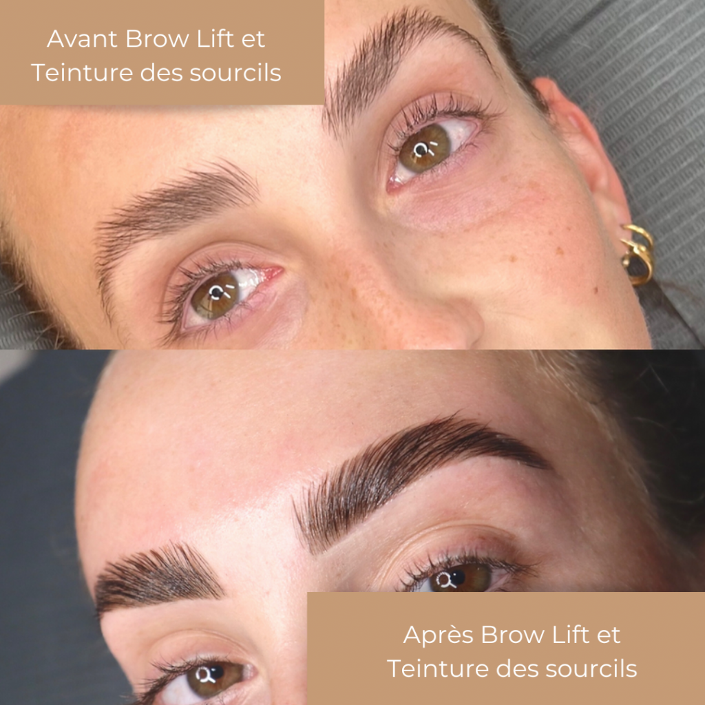 brow lift formation
