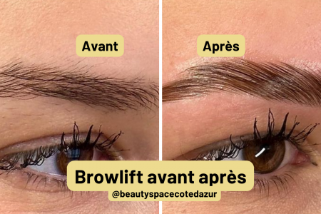 brow lift avant apres